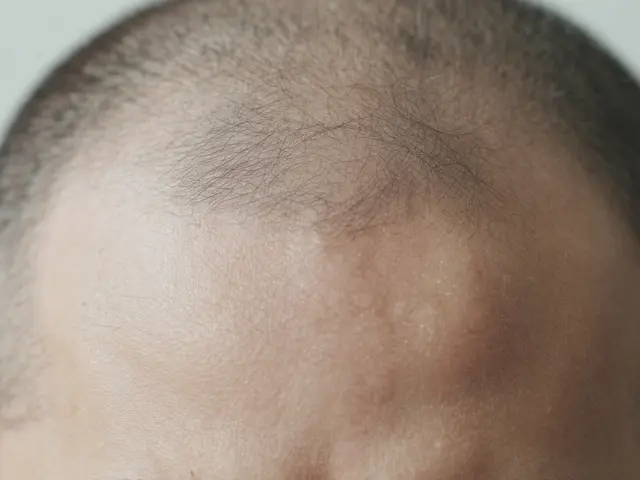 Proč mám suchou pokožku hlavy? Příčiny a jak s tím naložit